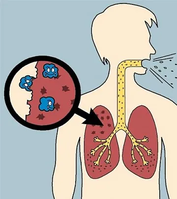 tuberculosis-foto