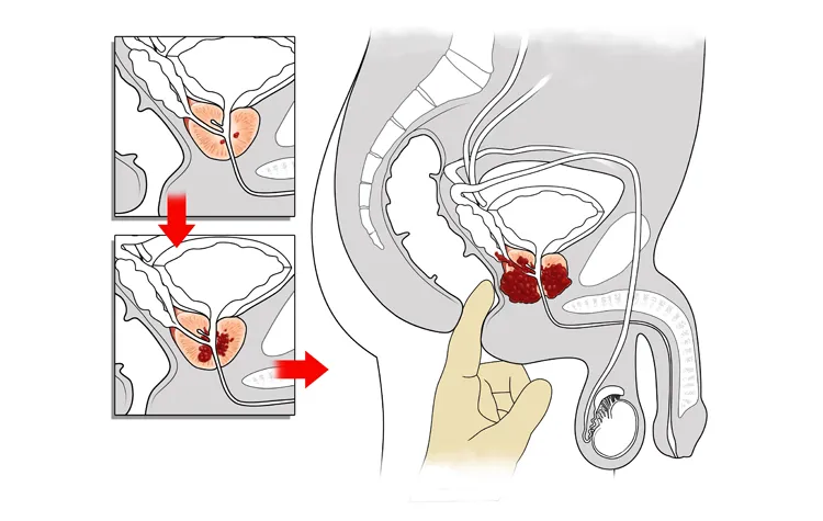 prostatit-foto