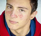 Себорея, Acne vulgaris, фото