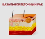 Базальноклеточный рак кожи