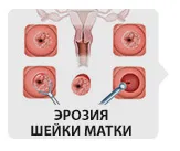 Эрозия
