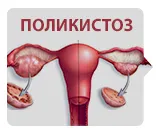 Поликистоз яичников