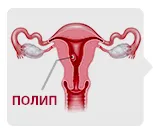 Полип эндометрия в матке