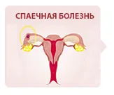 Спаечная болезнь