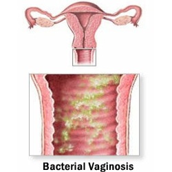 Bacterial Vaginosis -foto