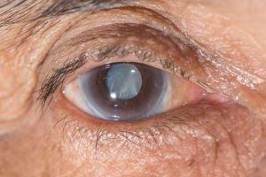 Глаукома, причины, симптомы, лечение и профилактика, фото