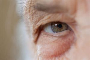 Глаукома, причины, симптомы, лечение и профилактика