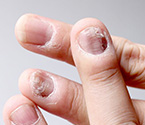 Псориаз ногтей, лечение