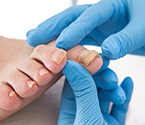 Как лечить псориаз ногтей