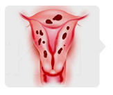 Аденомиоз матки, симптомы и лечение