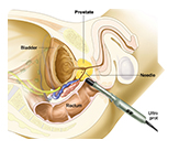 Где сделать ТРУЗИ простаты в СПб