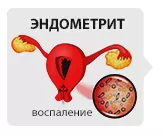 Эндометрит, лечение в СПб Эндометрит