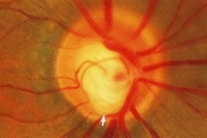 Открытоугольная глаукома, причины, симптомы, лечение и профилактика
